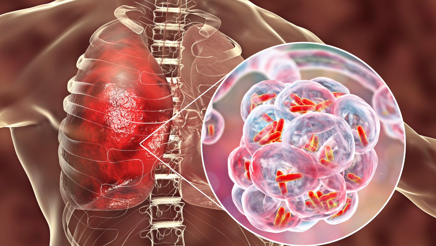 Infecção Polimicrobiana: O Que É, Principais Causas, Sintomas e Como Tratar?