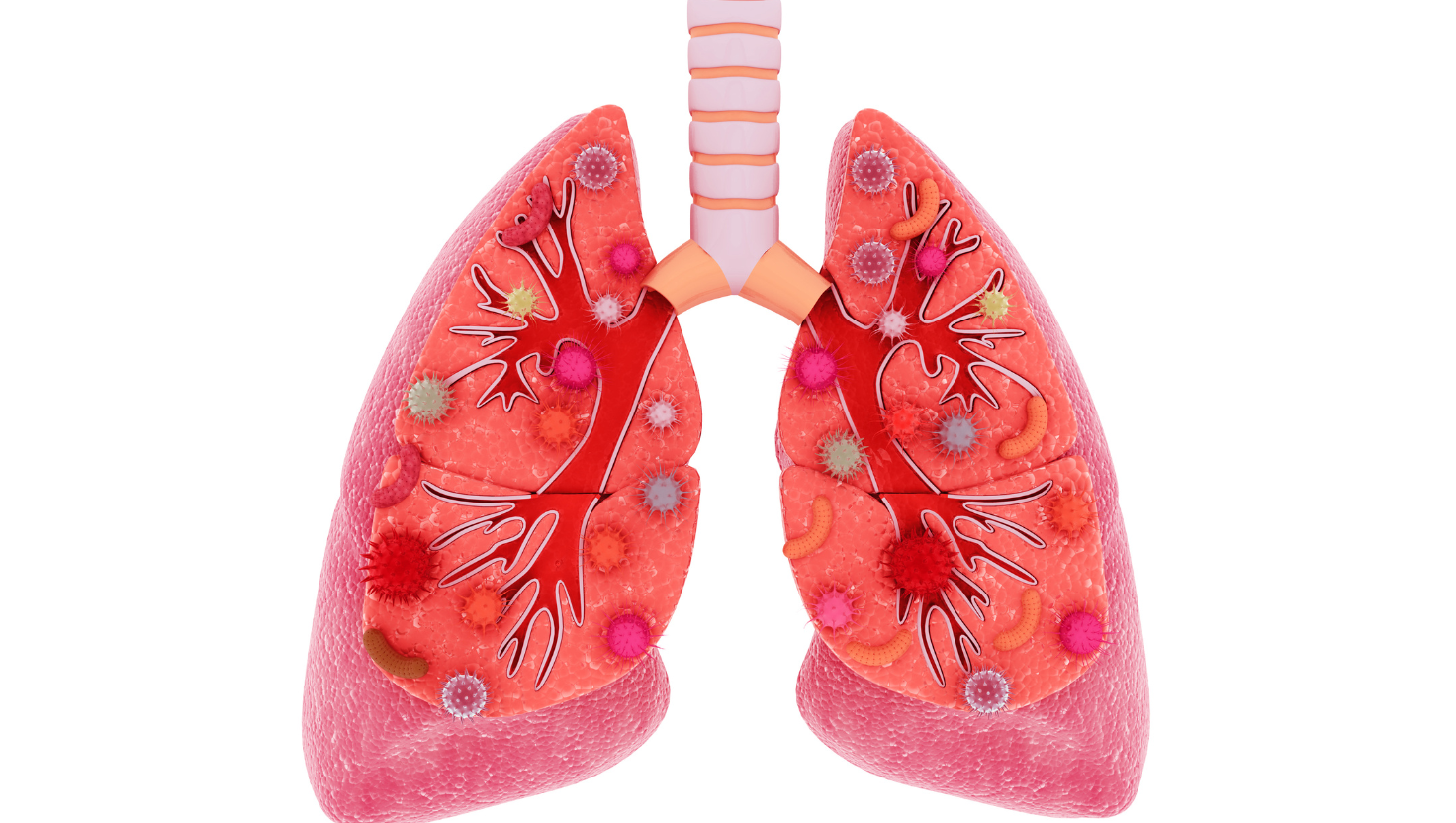 Pneumonia Bilateral: O Que É, Principais Causas e Como Tratar