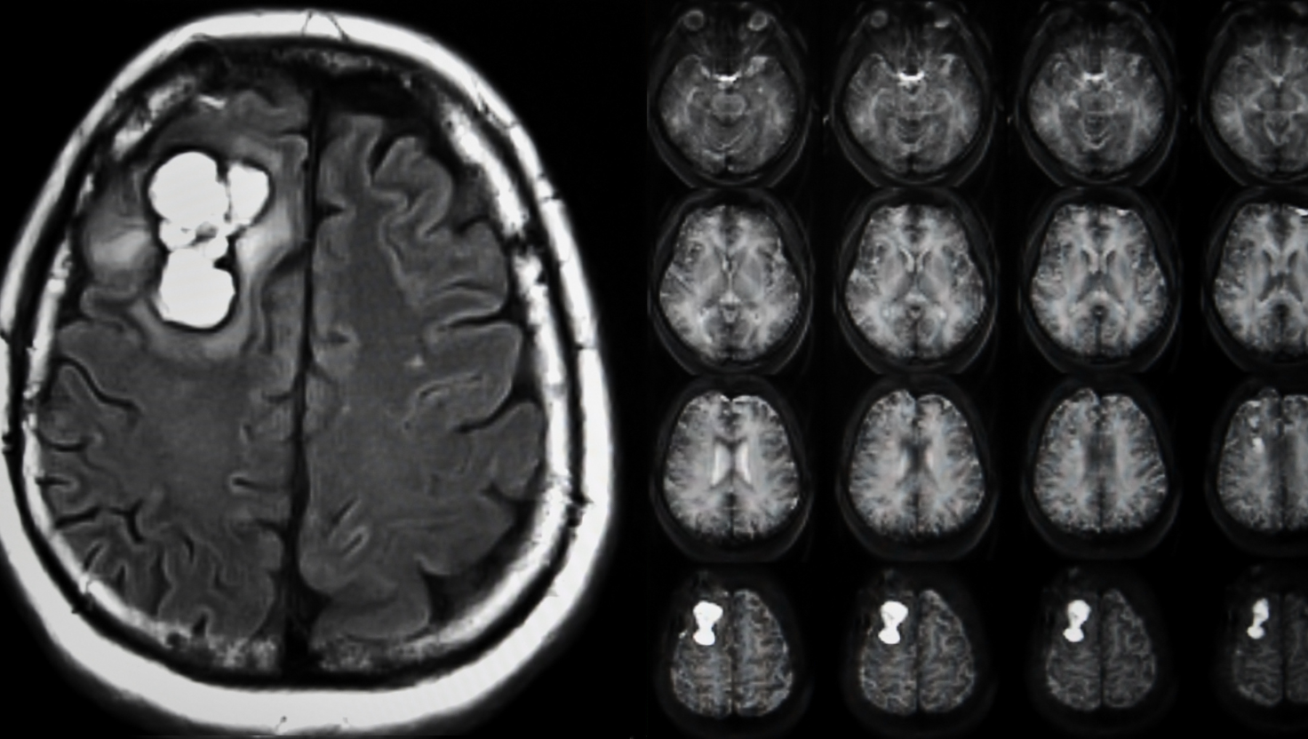 Glioma: O que é, principais sintomas e opções de tratamento