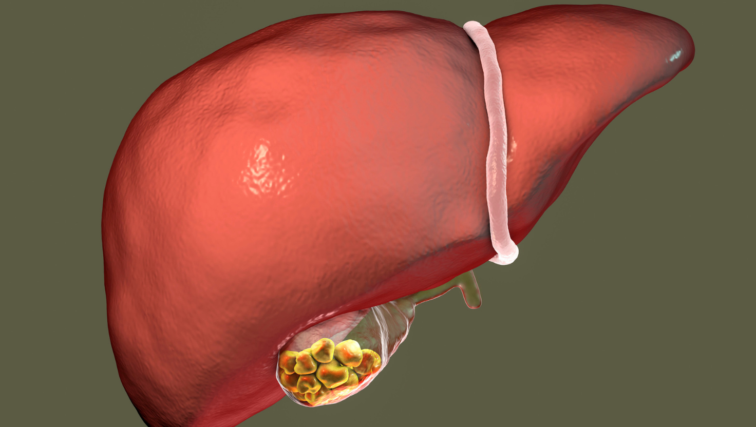 Pedra na Vesícula: Quando a Cirurgia é Necessária e Como Identificar os Sinais