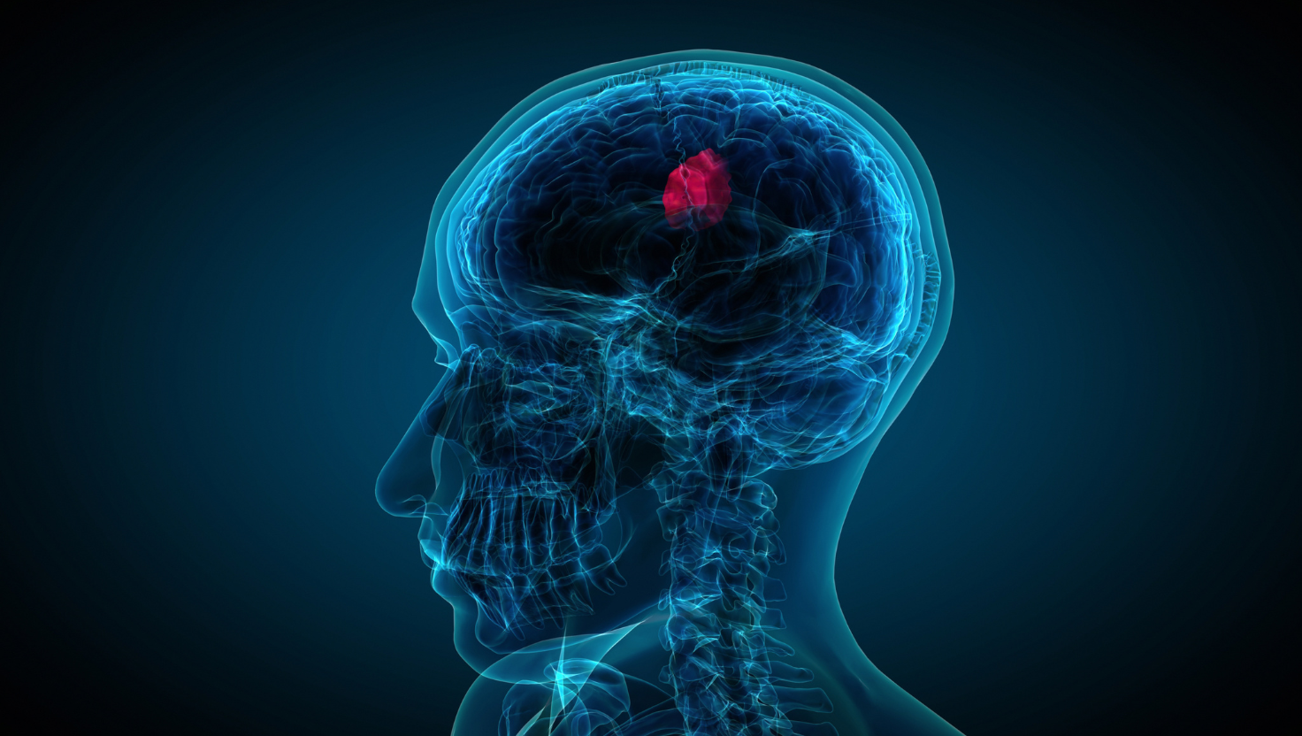 Tumor de Hipófise: Principais Sintomas, Diagnóstico e Opções de Tratamento