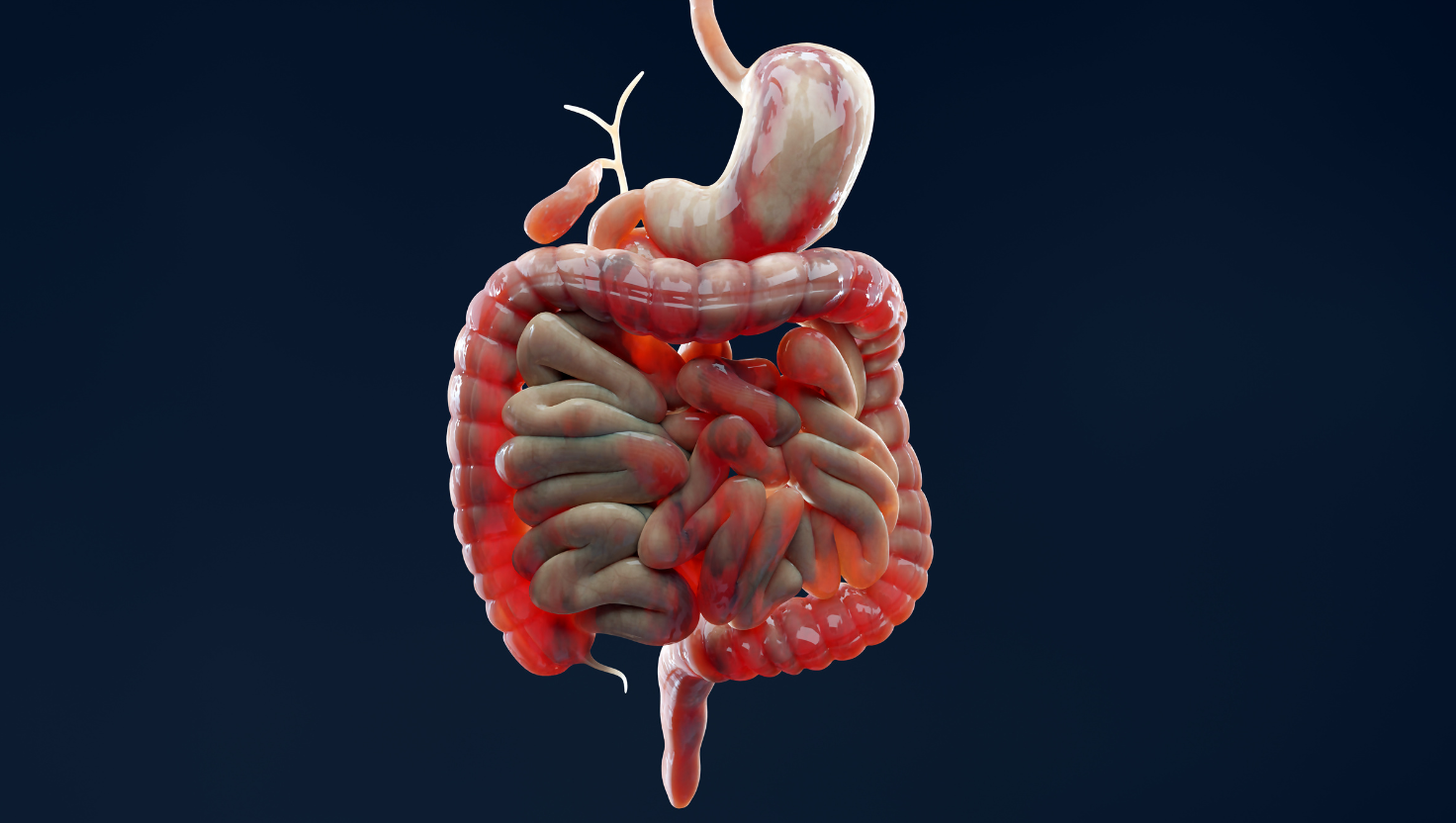 Doença de Crohn: É Possível Manter uma Vida Social Ativa Durante as Crises?