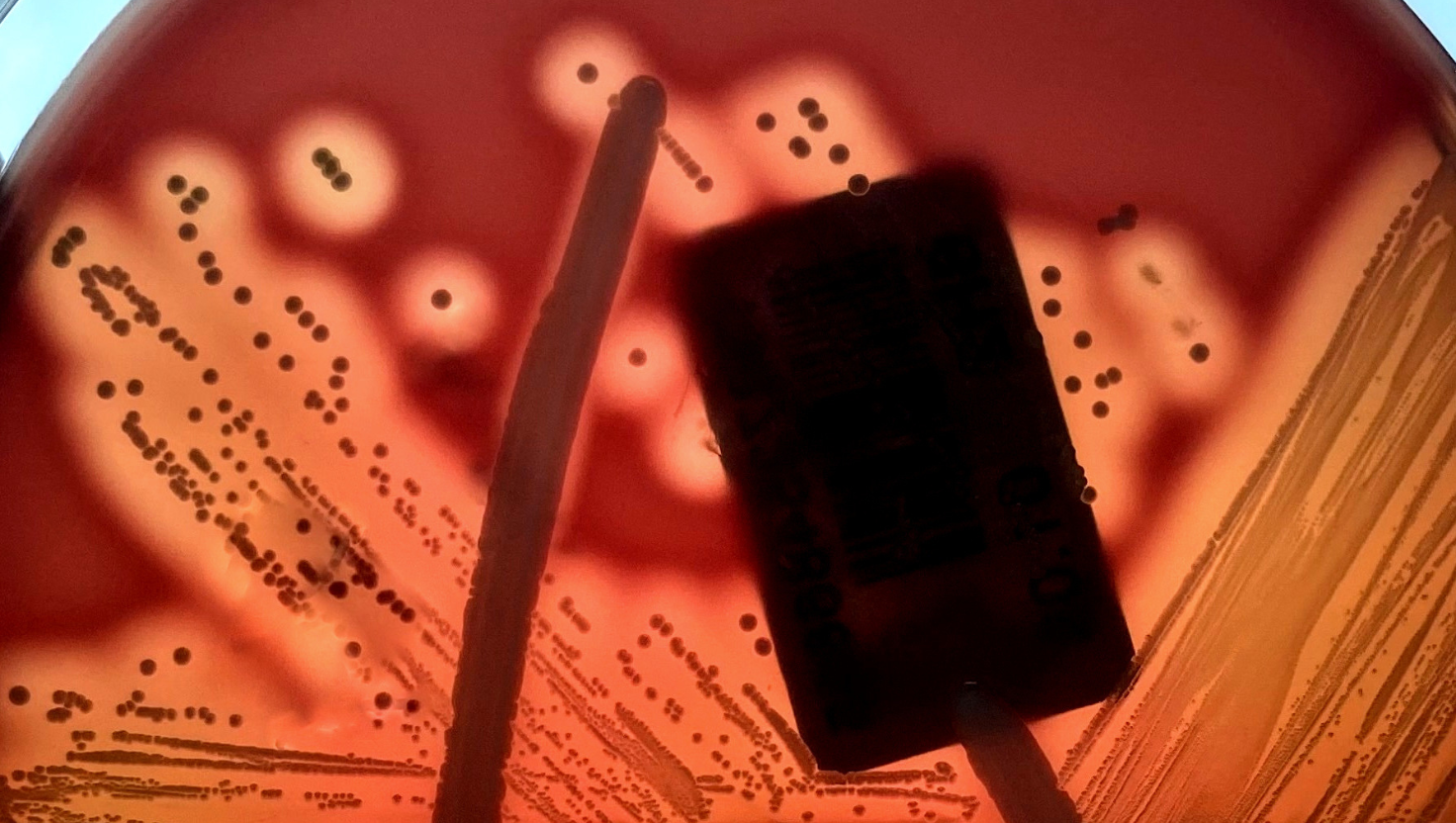Streptococcus agalactiae no Líquor de Recém-Nascidos: Diagnóstico, Riscos e Tratamento