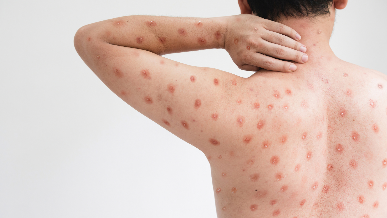 Mpox no Brasil: A Doença é um Novo Alerta de Saúde Pública?