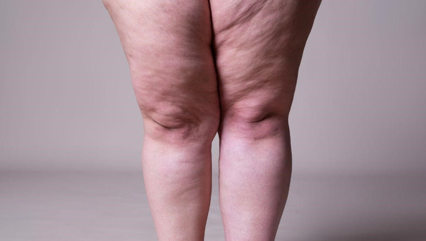 Lipedema: Entre o Desconforto e a Busca pela Estética