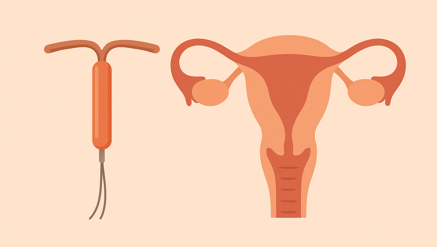 DIU Hormonal Agora Está Disponível no SUS para Tratamento da Endometriose
