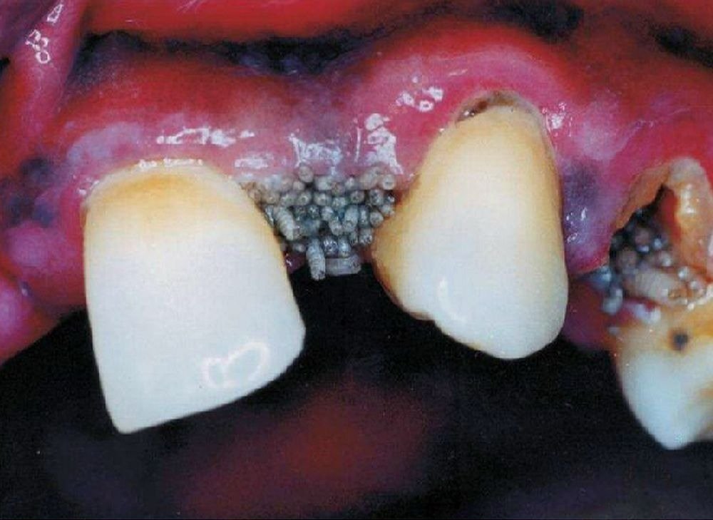 Miíase Oral: Causas, Sintomas e Tratamentos Eficazes