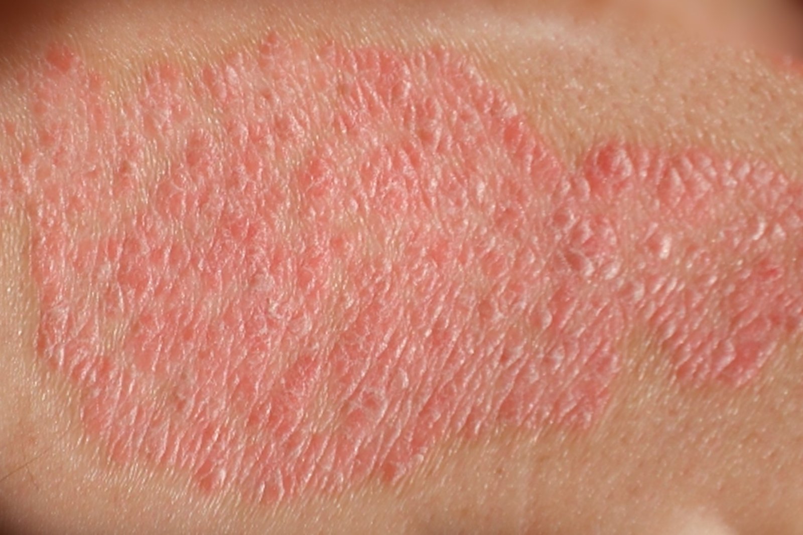 Psoríase e Hepcidina: Qual a Relação e o que a Ciência Já Descobriu?
