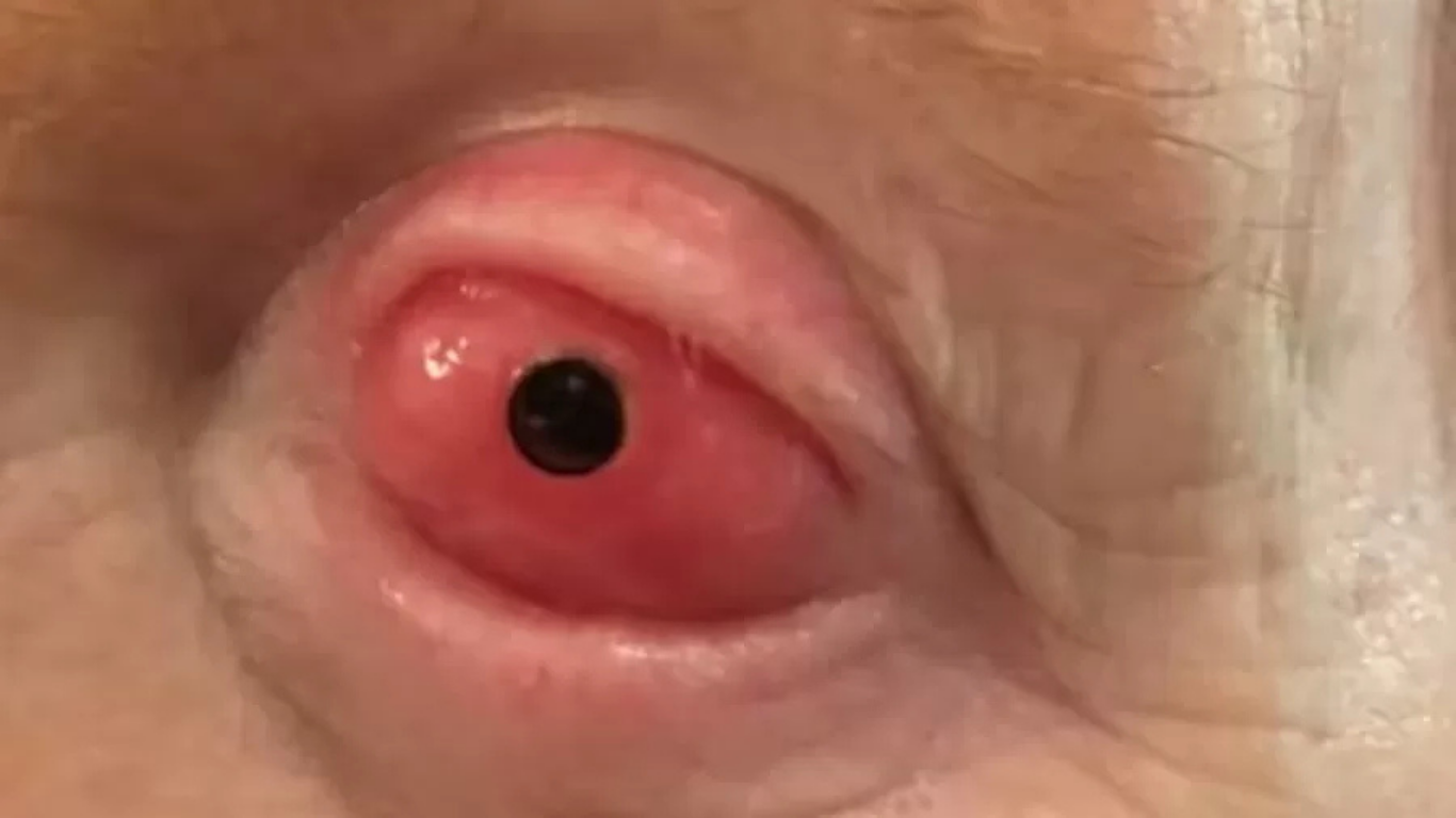 Cirurgia “Dente no Olho”: Uma Nova Esperança Para Pacientes com Deficiência Visual