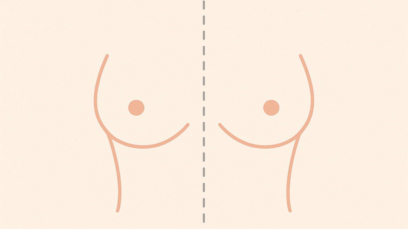 Mastopexia com Cicatriz Discreta: Seios Mais Firmes e Naturais com Resultado Estético Harmonioso