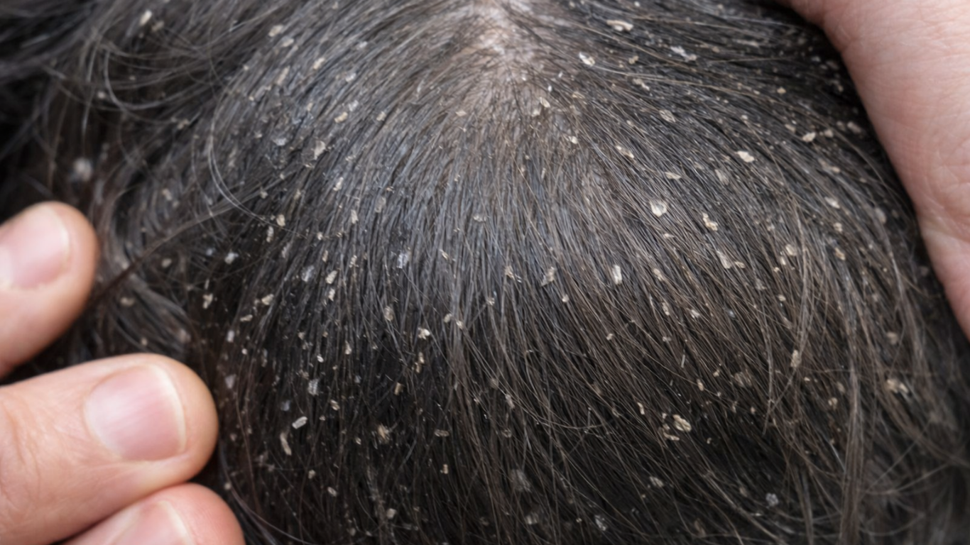 Pediculose e volta às aulas: como prevenir piolhos, identificar sinais e evitar surtos nas escolas